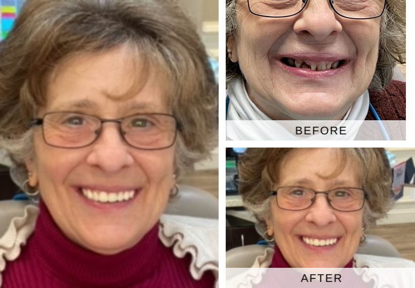 Before and after images of patient Mary