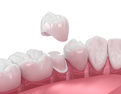 Illustration of dental crown being attached to prepared tooth