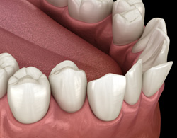 Illustration of a crowded teeth