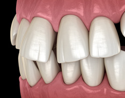Illustration of gapped teeth