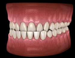 Illustration of an underbite