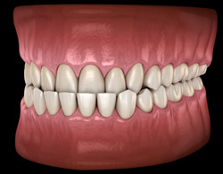 Illustration of a crossbite