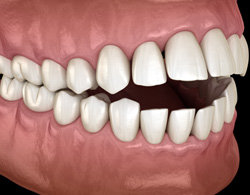 Illustration of an open bite