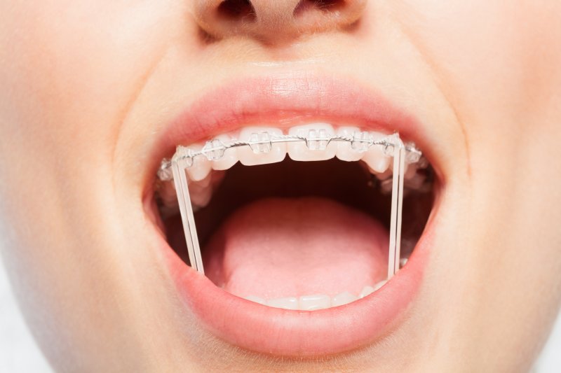 How Rubber Bands For Braces Help Align Your Teeth During Treatment? -  Dental Health Clinic