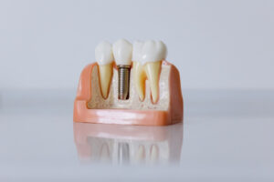 Model of dental implant