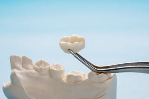 Close up of a dental crown being plucked from a wax model