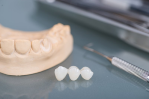 A dental bridge sitting next to a wax model of a lower dental arch